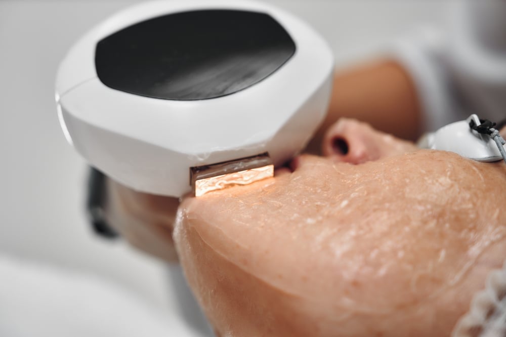 Aesthelite Plus IPL treatment for freckles, age spots, and visible pigmentation
