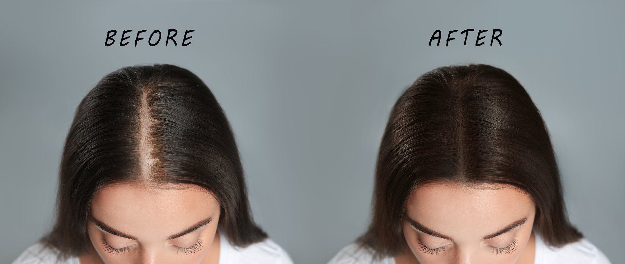 Hair restoration treatment designed to support fuller-looking hair