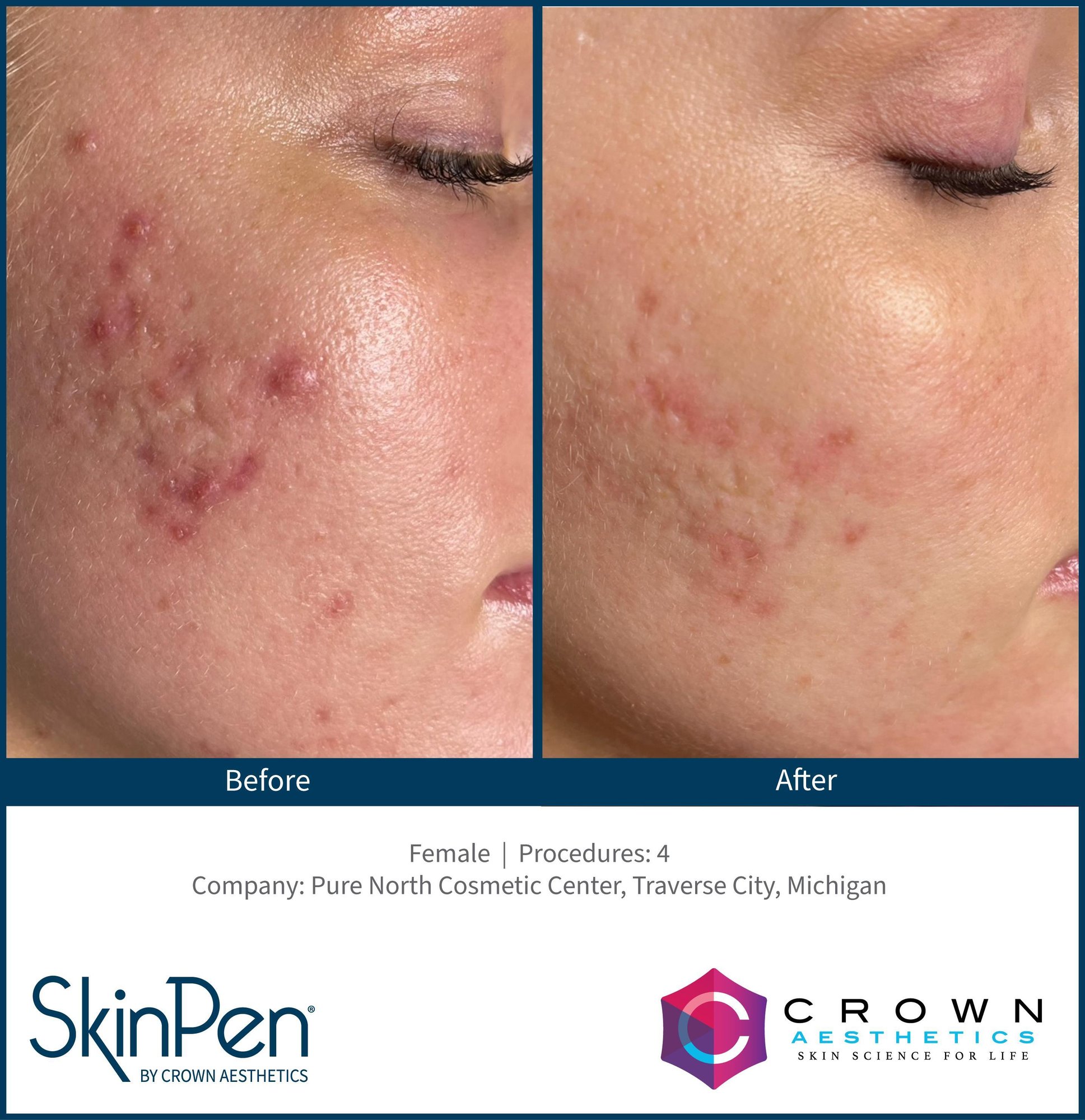 Microneedling before and after for acne scars using SkinPen in Chattanooga TN