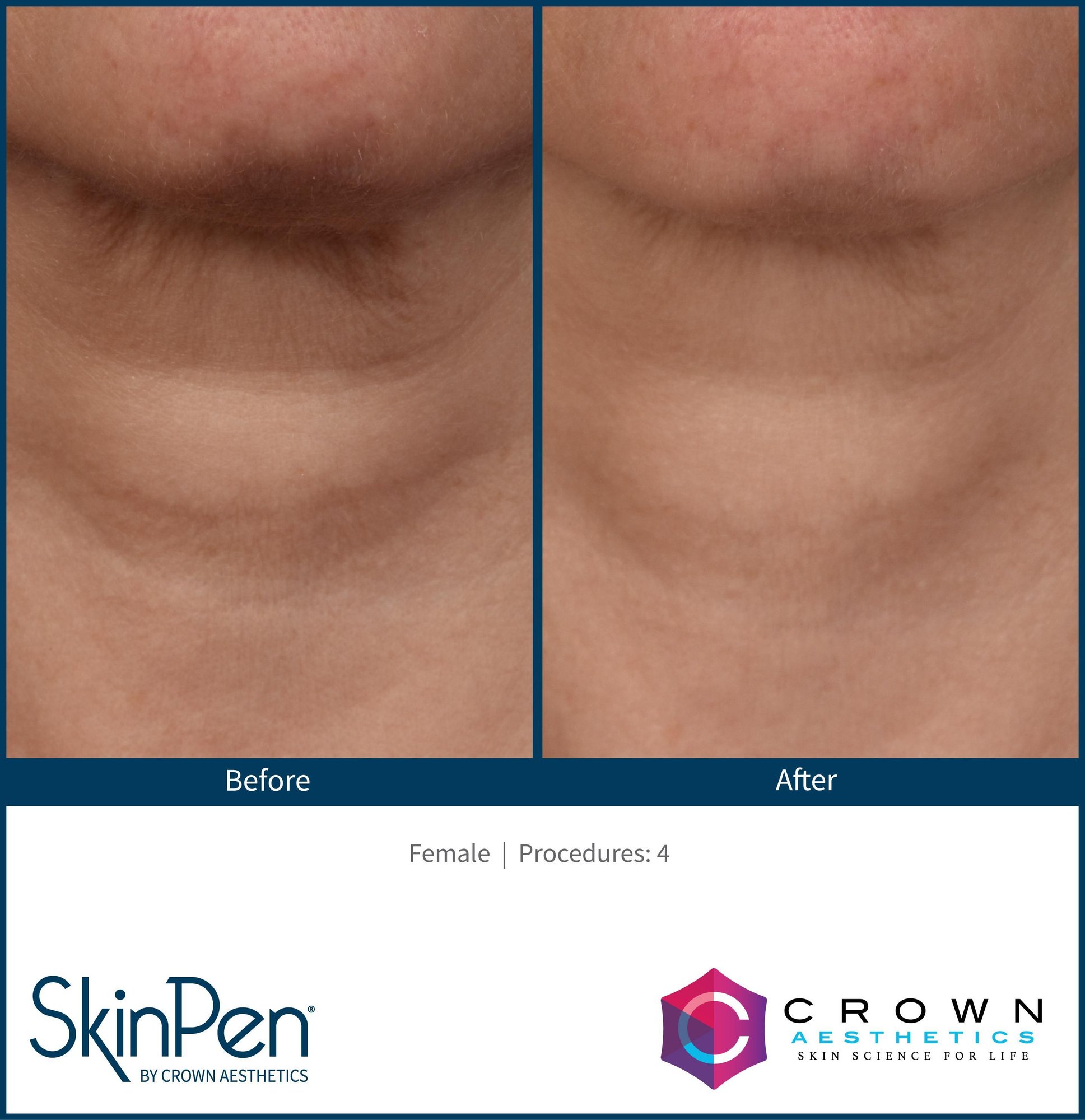 SkinPen before and after neck wrinkle treatment with smoother skin texture in Chattanooga TN