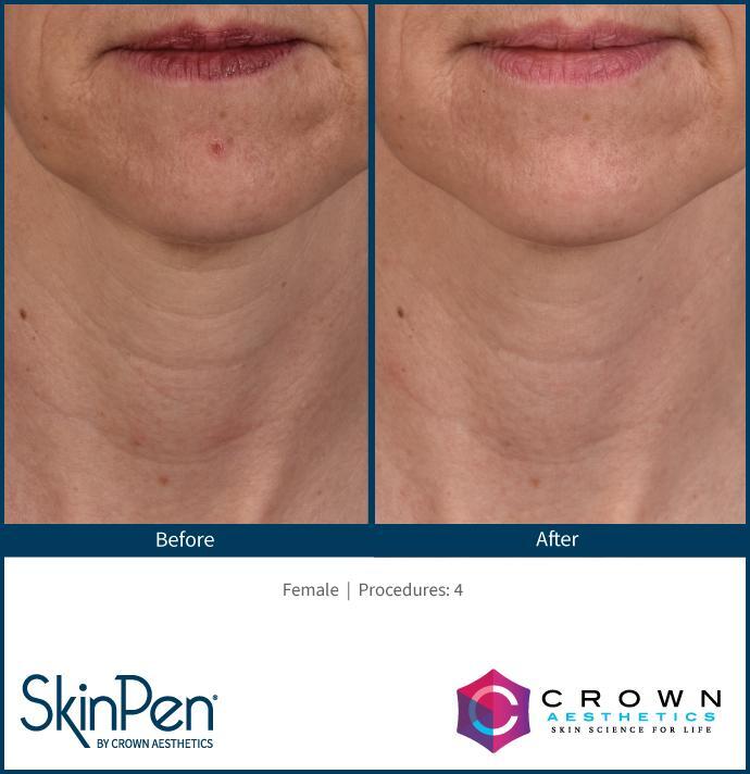 Professional microneedling before and after showing improved skin texture in Chattanooga TN