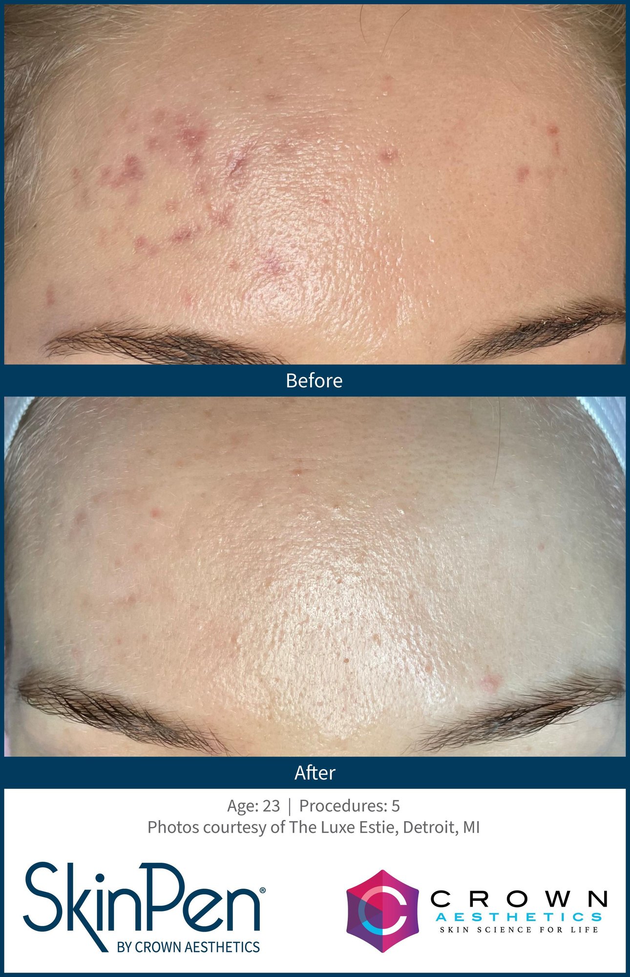 SkinPen microneedling results before and after for acne scar treatment in Chattanooga TN