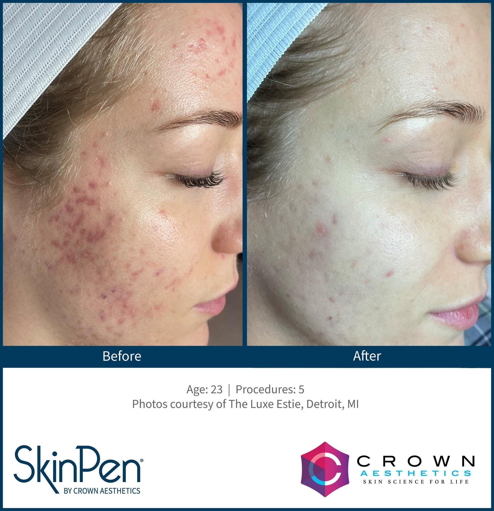 Microneedling before and after for wrinkles on the neck at CFR Aesthetics in Chattanooga TN