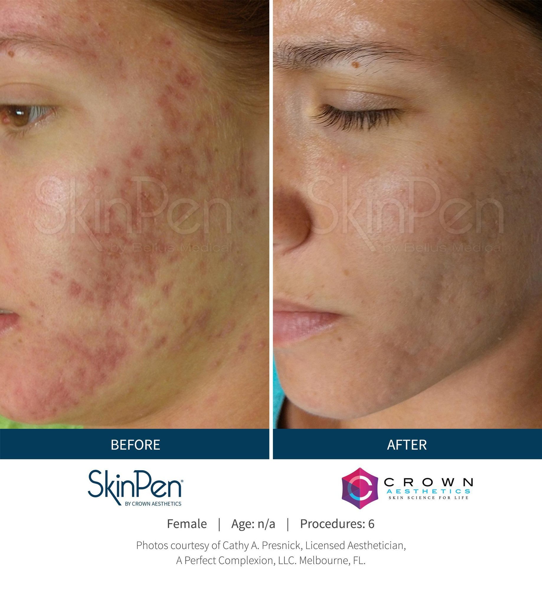SkinPen before and after for uneven skin texture and acne scars in Chattanooga TN