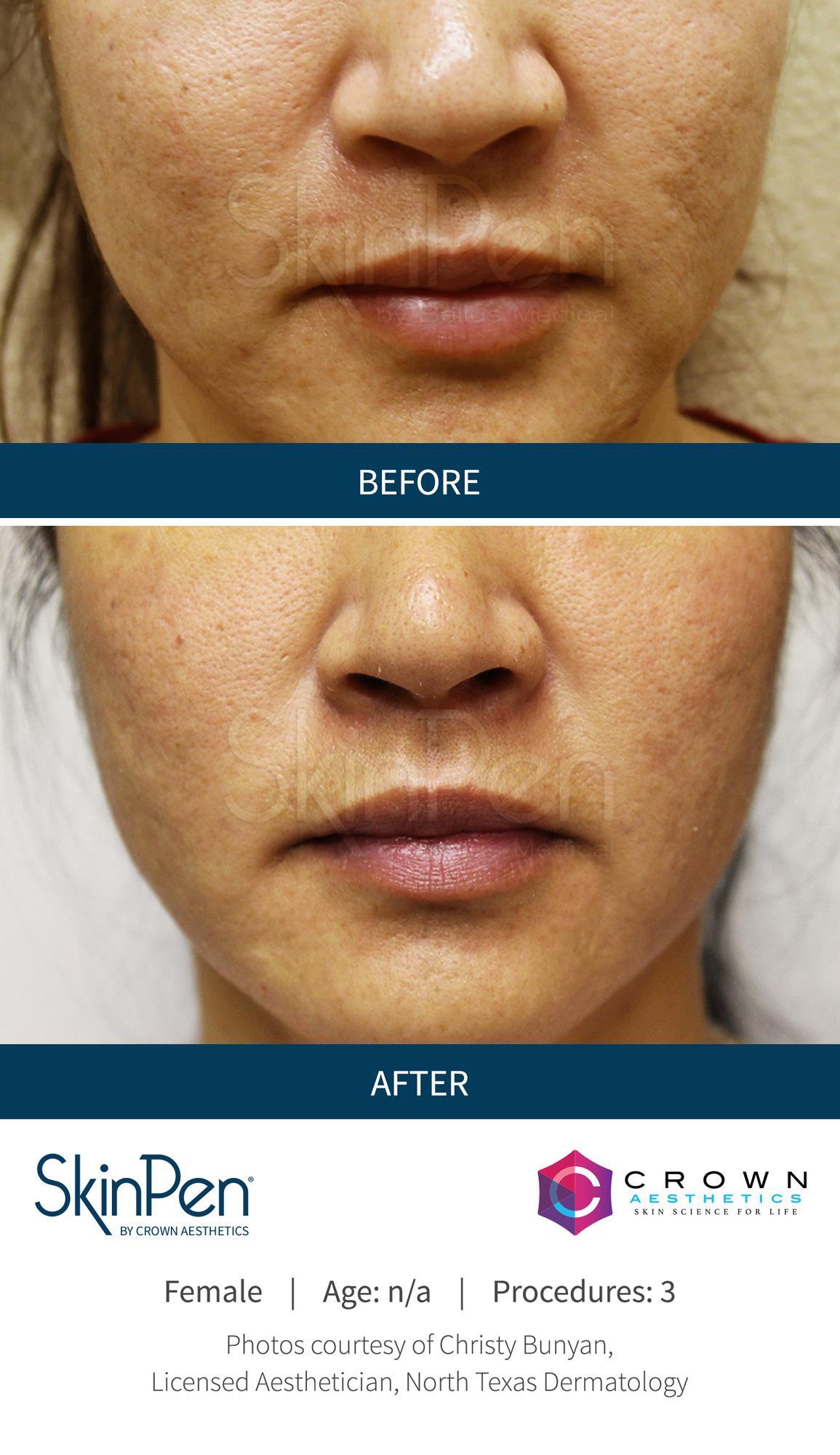 SkinPen before and after showing smoother skin and refined texture in Chattanooga TN