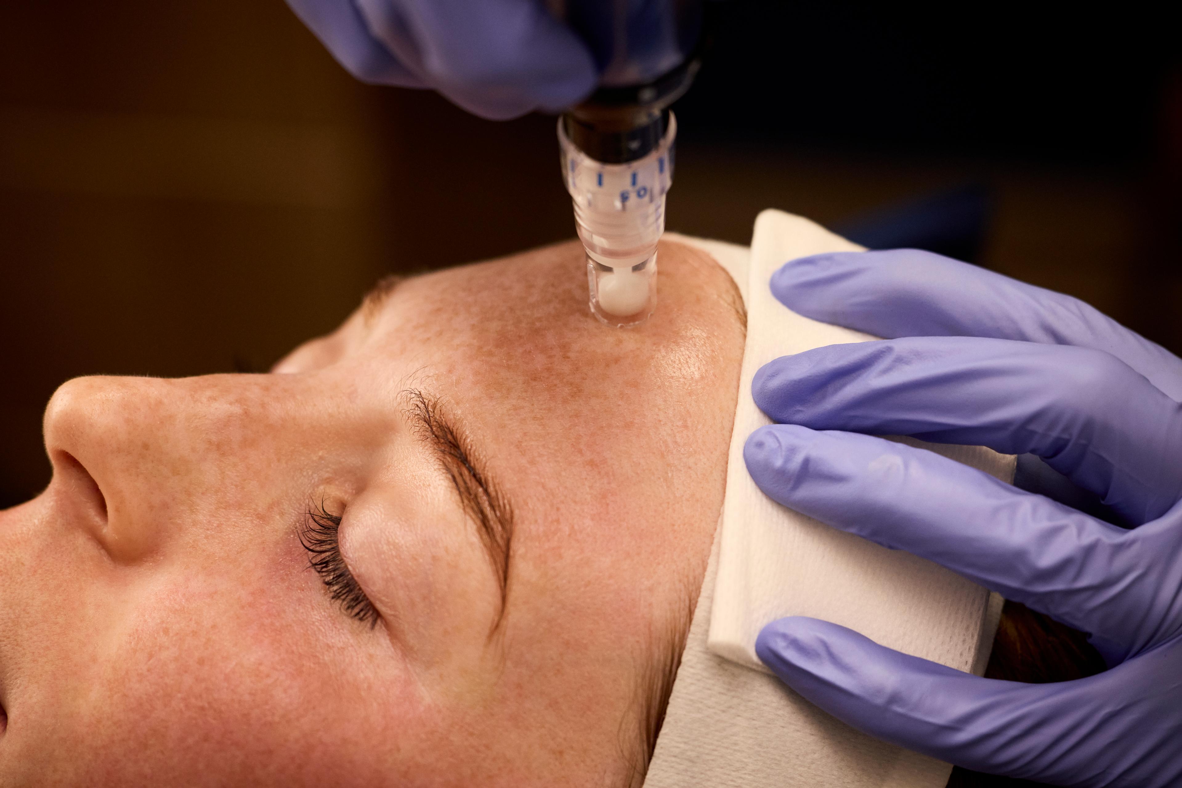 SkinPen Precision microneedling device used for professional skin rejuvenation treatment