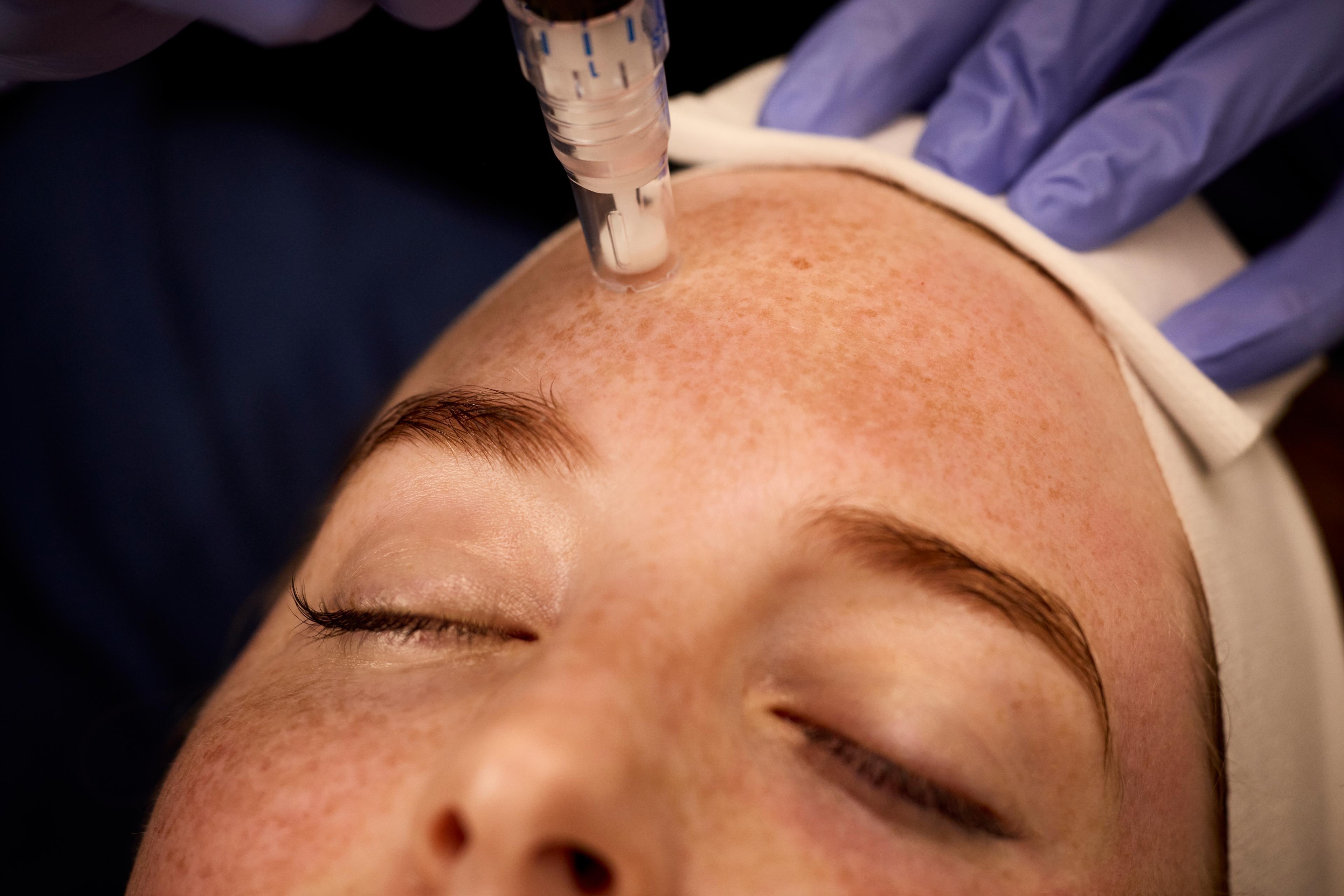 SkinPen microneedling treatment at CFR Aesthetics in Chattanooga TN for smoother skin texture