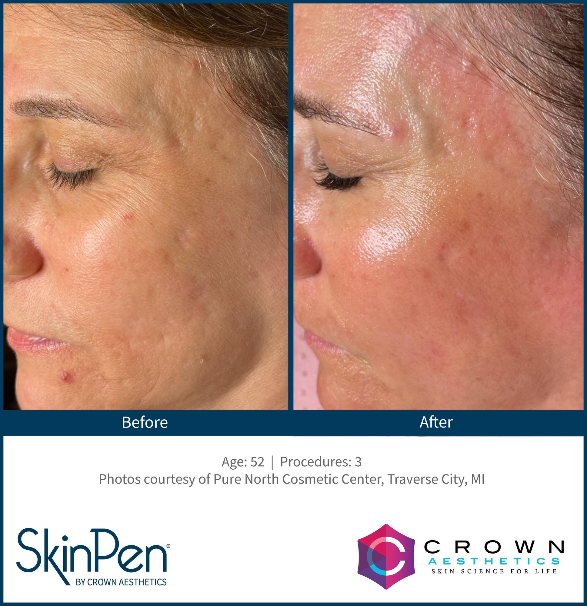 SkinPen before and after results for facial acne scars at CFR Aesthetics in Chattanooga TN