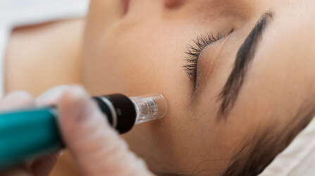 co2-laser-resurfacing