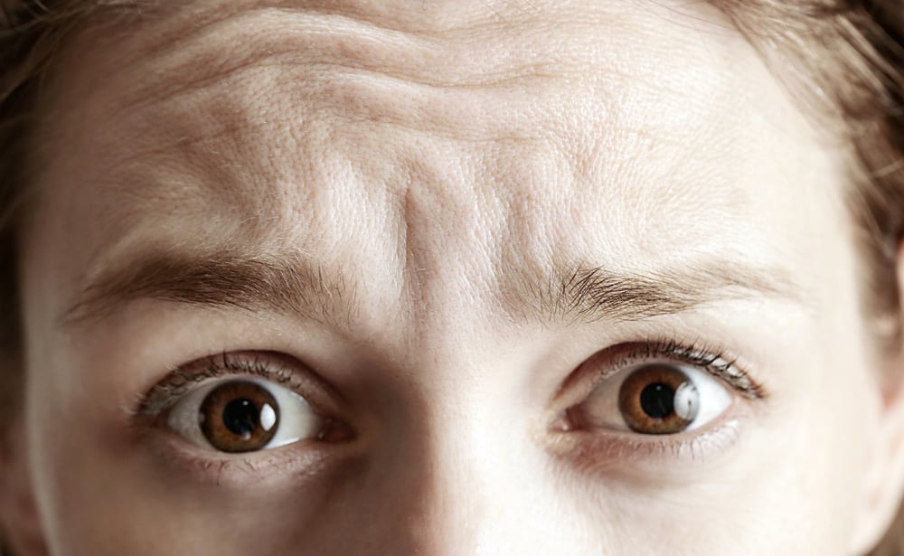 RHA filler Chattanooga dynamic wrinkles natural facial expressions treatment