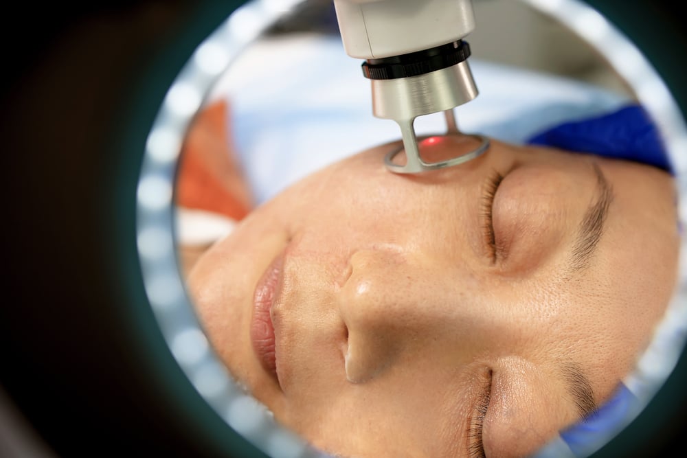 CO2 laser resurfacing for wrinkles and sun damage at CFR Aesthetics