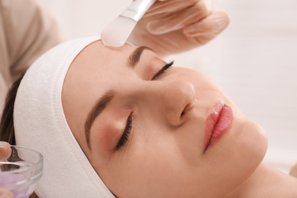 VI Peel treatment for acne prone skin and post acne marks
