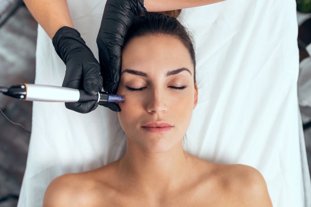 Microneedling treatment in Chattanooga TN for collagen stimulation