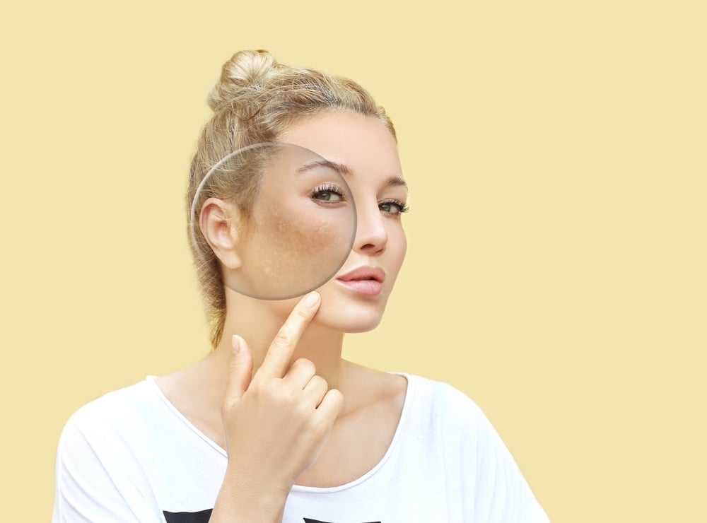 Microneedling for hyperpigmentation and sun damage in Chattanooga, TN