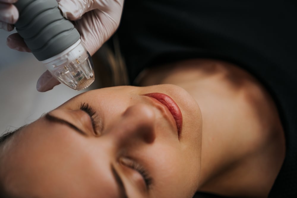 RF microneedling for acne scars and wrinkles Chattanooga TN