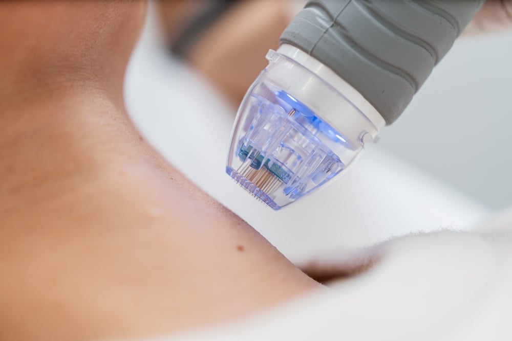 Radiofrequency microneedling procedure at CFR Aesthetics Chattanooga