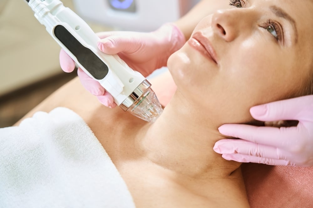 RF microneedling device delivering heat and collagen stimulation