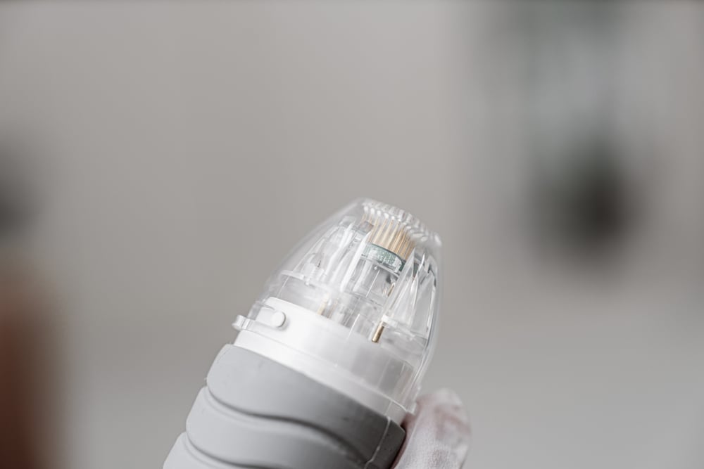 Before and after RF microneedling results for smoother skin