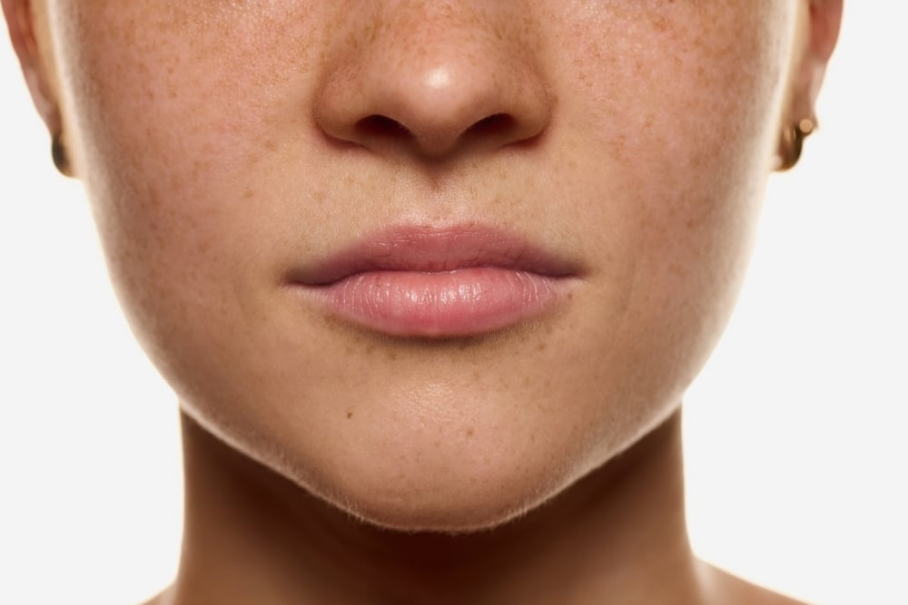 Patient receiving Kybella injections Chattanooga aesthetic clinic