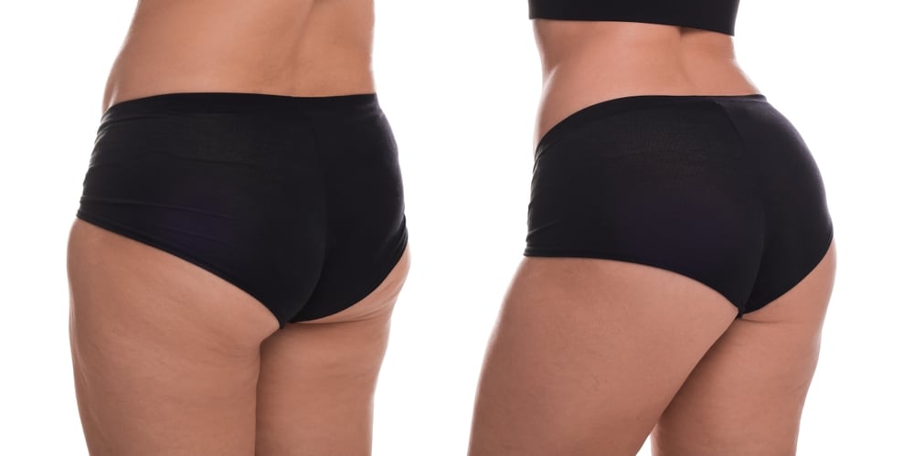 CoolTone before and after photo showing body toning results
