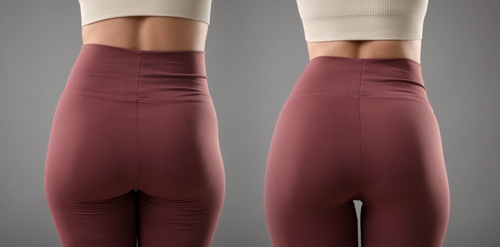 Non-invasive muscle toning before and after results with CoolTone